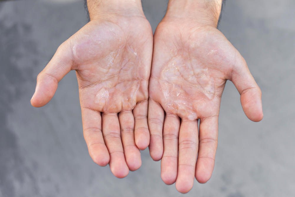 Close-up of cracked hands needing hydration with soothing lotion.