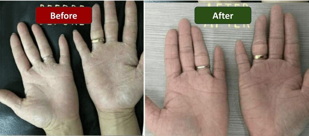 Customer relief from  cracked and dry palms after using Yagishi lotion