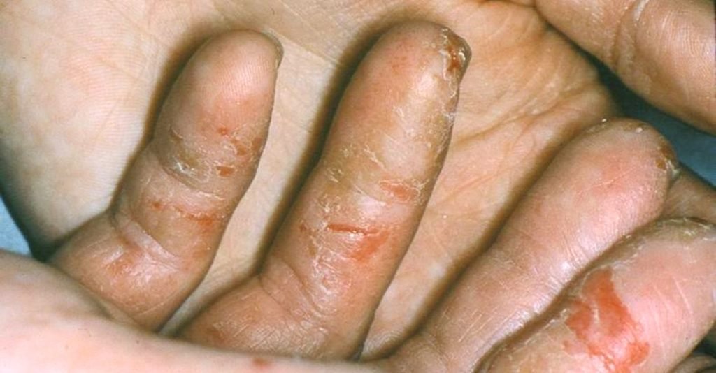How Long Does Eczema Rash Last? Causes, Flare-Ups & Natural Relief