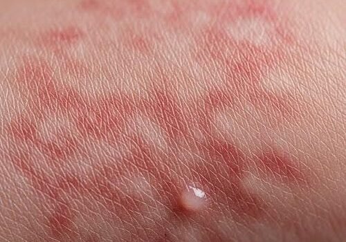 Eczema flare-ups